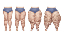 4 Stages of Lipedema
